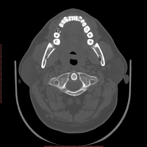 File:Chronic submandibular sialolithiasis (Radiopaedia 69817-79814 Axial bone window 34).jpg