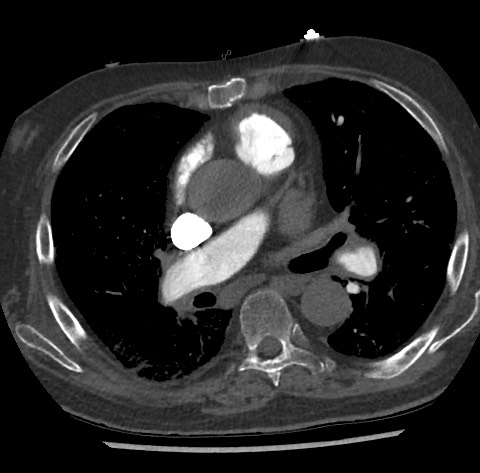 File:Chronic thromboembolic pulmonary disease (Radiopaedia 90694-108119 Axial C+ CTPA 49).jpg