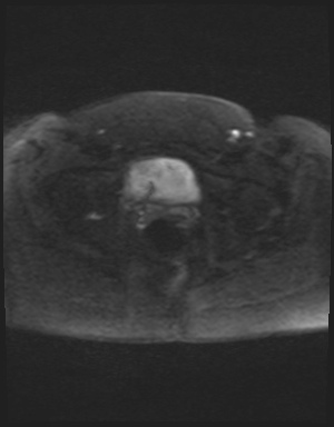Class II Mullerian duct anomaly- unicornuate uterus with rudimentary horn and non-communicating cavity (Radiopaedia 39441-41755 Axial DWI 54).jpg