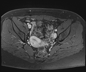 File:Class II Mullerian duct anomaly- unicornuate uterus with rudimentary horn and non-communicating cavity (Radiopaedia 39441-41755 Axial T1 fat sat 57).jpg