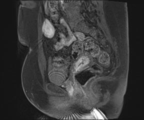 Class II Mullerian duct anomaly- unicornuate uterus with rudimentary horn and non-communicating cavity (Radiopaedia 39441-41755 G 50).jpg