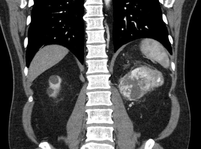 File:Clear cell renal cell carcinoma (Radiopaedia 61449-69393 C 35).jpg