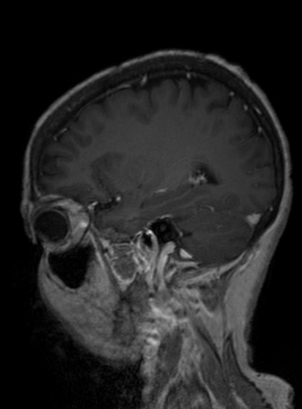 Clival meningioma (Radiopaedia 53278-59248 Sagittal T1 C+ 314).jpg