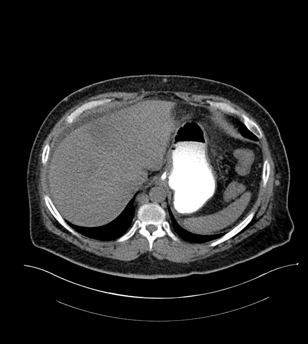 Closed-loop small bowel obstruction-internal hernia (Radiopaedia 78439-91096 Axial non-contrast 27).jpg