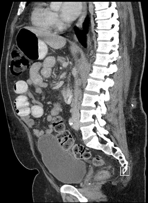 Closed loop obstruction - internal hernia into nephrectomy bed (Radiopaedia 59867-67320 C 49).jpg