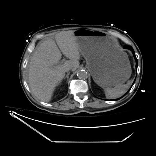 File:Closed loop obstruction due to adhesive band, resulting in small bowel ischemia and resection (Radiopaedia 83835-99023 Axial non-contrast 37).jpg