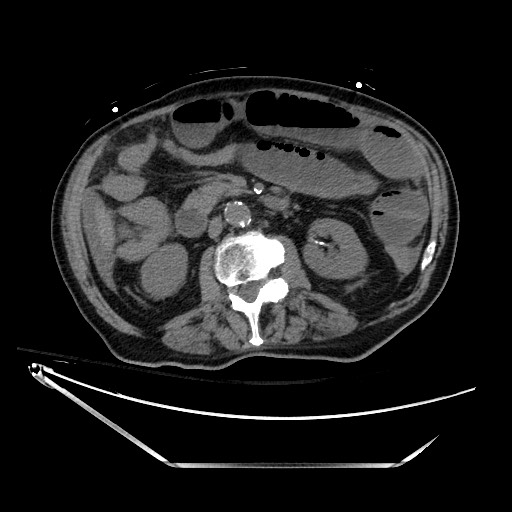 Closed loop obstruction due to adhesive band, resulting in small bowel ischemia and resection (Radiopaedia 83835-99023 Axial non-contrast 68).jpg