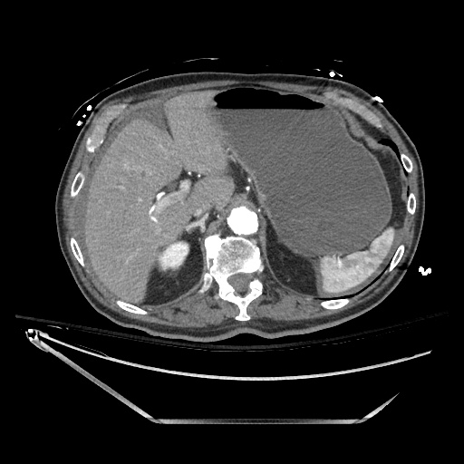 File:Closed loop obstruction due to adhesive band, resulting in small bowel ischemia and resection (Radiopaedia 83835-99023 B 38).jpg