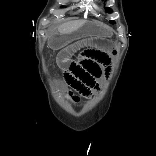 File:Closed loop obstruction due to adhesive band, resulting in small bowel ischemia and resection (Radiopaedia 83835-99023 C 24).jpg