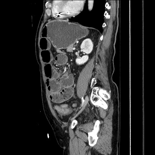 Closed loop obstruction due to adhesive band, resulting in small bowel ischemia and resection (Radiopaedia 83835-99023 F 119).jpg