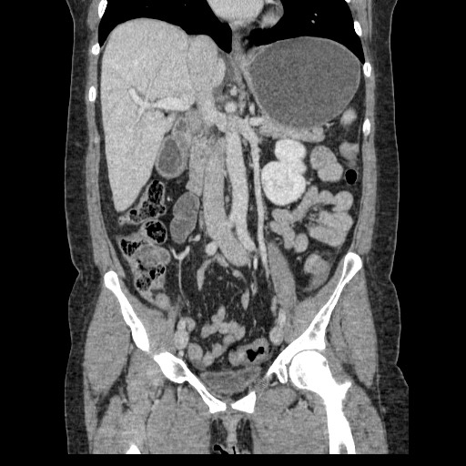 Closed loop small bowel obstruction (Radiopaedia 65403-74451 B 55).jpg