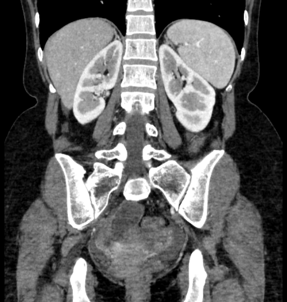 Closed loop small bowel obstruction (Radiopaedia 71211-81508 B 90).jpg