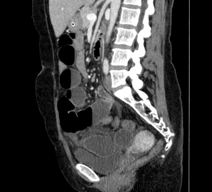 Closed loop small bowel obstruction (Radiopaedia 71211-81508 C 82).jpg