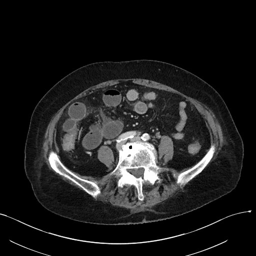 File:Closed loop small bowel obstruction - adhesions (Radiopaedia 59269-66611 Axial 12).jpg