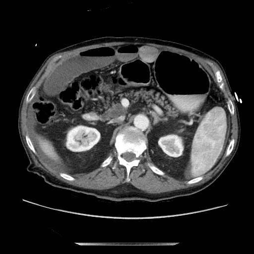 Closed loop small bowel obstruction - adhesive disease and hemorrhagic ischemia (Radiopaedia 86831-102990 A 72).jpg