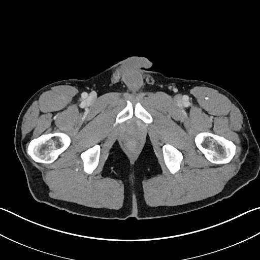 Closed loop small bowel obstruction - internal hernia (Radiopaedia 57806-64778 B 133).jpg