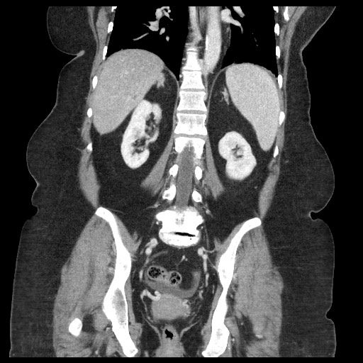 Closed loop small bowel obstruction - internal hernia (Radiopaedia 65402-74450 B 75).jpg
