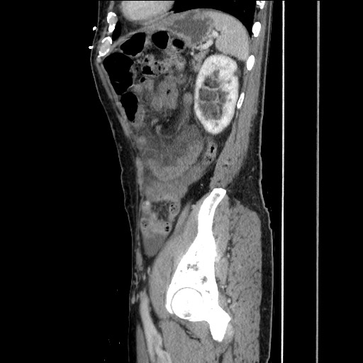 Closed loop small bowel obstruction - omental adhesion causing "internal hernia" (Radiopaedia 85129-100682 C 135).jpg