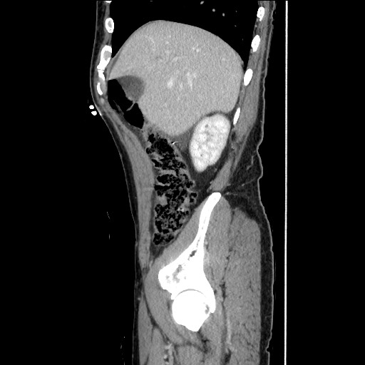File:Closed loop small bowel obstruction - omental adhesion causing "internal hernia" (Radiopaedia 85129-100682 C 49).jpg