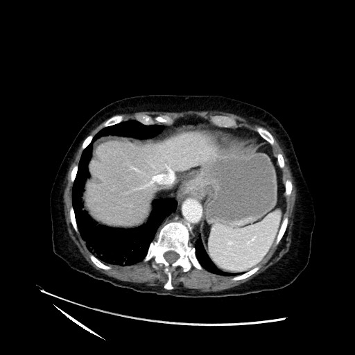 File:Closed loop small bowel obstruction due to adhesive band, with intramural hemorrhage and ischemia (Radiopaedia 83831-99017 Axial 115).jpg