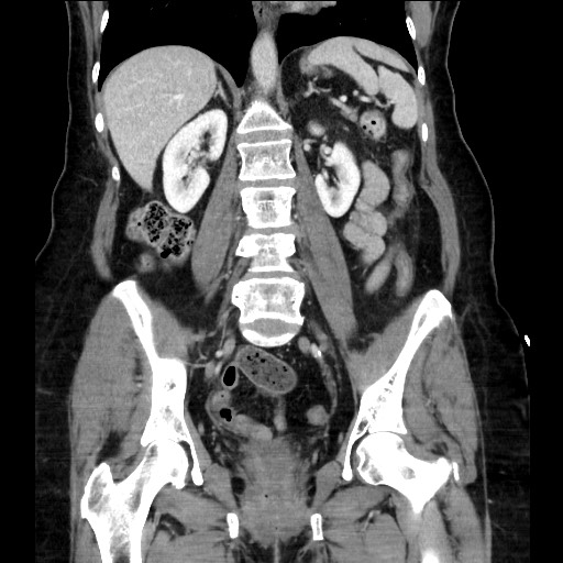 File:Closed loop small bowel obstruction due to adhesive bands - early and late images (Radiopaedia 83830-99014 B 78).jpg