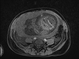 Closed loop small bowel obstruction in pregnancy (MRI) (Radiopaedia 87637-104031 F 23).jpg
