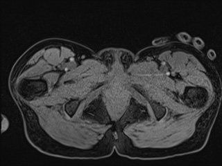 Closed loop small bowel obstruction in pregnancy (MRI) (Radiopaedia 87637-104031 G 35).jpg