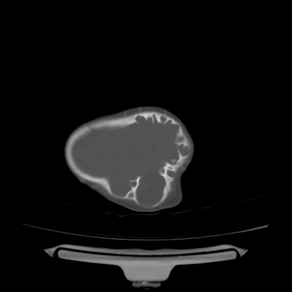 Cloverleaf skull (Radiopaedia 91901-109710 Axial bone window 131).jpg