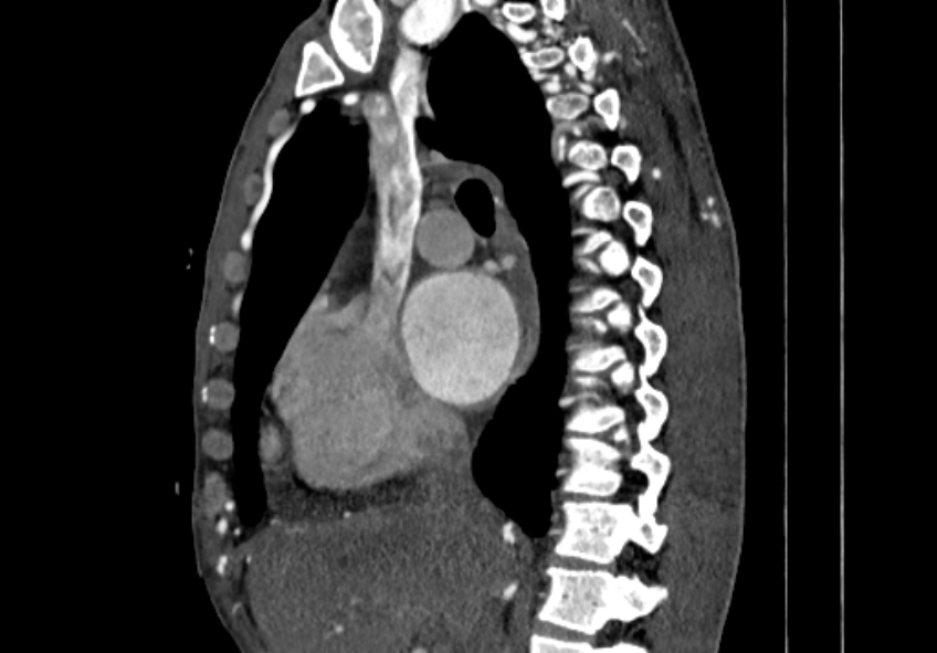 Coarctation of aorta with aortic valve stenosis (Radiopaedia 70463-80574 B 28).jpg