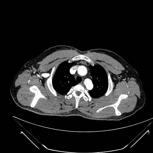 File:Coarctation of the aorta (Radiopaedia 49784-55050 B 31).jpg