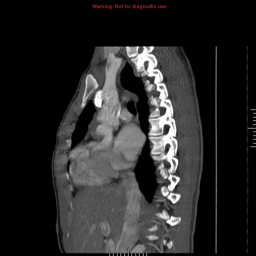 File:Coarctation of the aorta (Radiopaedia 9434-10118 B 22).jpg