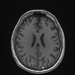 File:Cochlear incomplete partition type III associated with hypothalamic hamartoma (Radiopaedia 88756-105498 Axial T1 126).jpg
