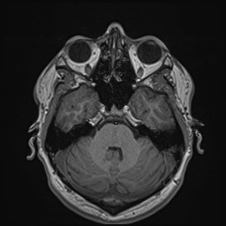 Cochlear incomplete partition type III associated with hypothalamic hamartoma (Radiopaedia 88756-105498 Axial T1 66).jpg