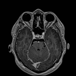 Cochlear incomplete partition type III associated with hypothalamic hamartoma (Radiopaedia 88756-105498 Axial T1 C+ 76).jpg