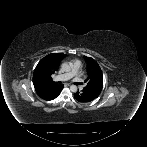 File:Collection due to leak after sleeve gastrectomy (Radiopaedia 55504-61972 A 1).jpg