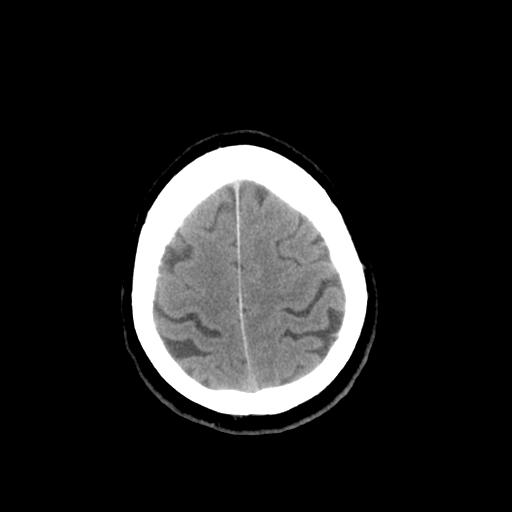 File:Colloid cyst (large) (Radiopaedia 34415-35734 Axial non-contrast 49).png