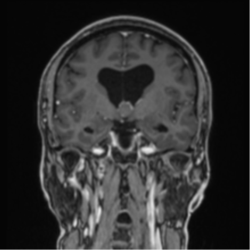 File:Colloid cyst of the third ventricle (Radiopaedia 86571-102662 Coronal T1 C+ 53).png