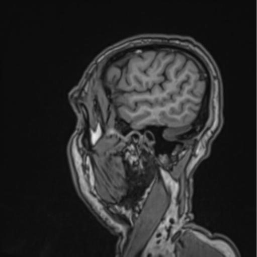 File:Colloid cyst of the third ventricle (Radiopaedia 86571-102662 Sagittal T1 66).png