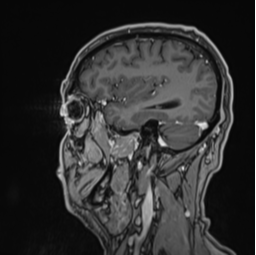 File:Colloid cyst of the third ventricle (Radiopaedia 86571-102662 Sagittal T1 C+ 59).png