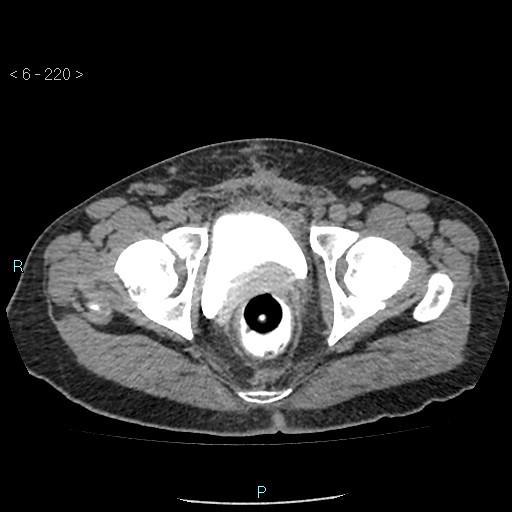 File:Colo-cutaneous fistula (Radiopaedia 40531-43129 A 92).jpg