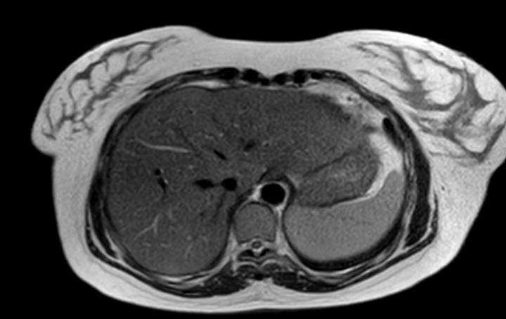 Colon adenocarcinoma with Krukenberg tumors, advanced pregnancy (Radiopaedia 67279-76645 Axial T2 74).jpg