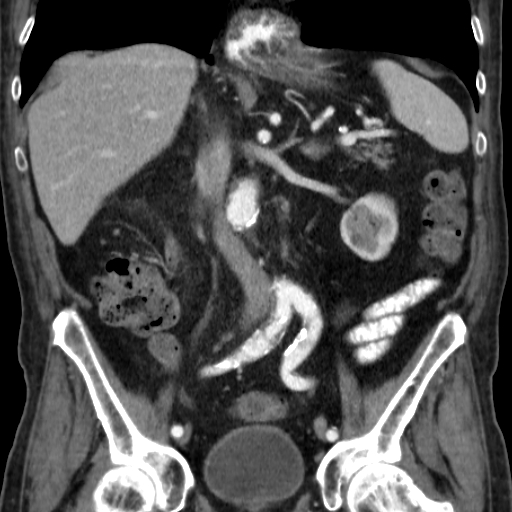 File:Colon cancer with duodenal invasion (Radiopaedia 16278-15958 B 33).jpg