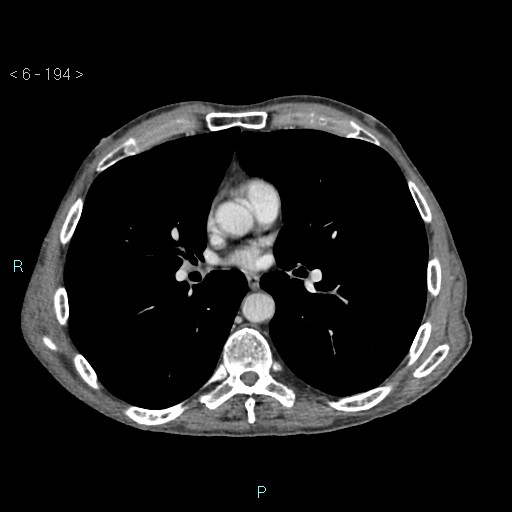 Colonic cancer (ultrasound and TC imaging) (Radiopaedia 50346-55713 B 194).jpg