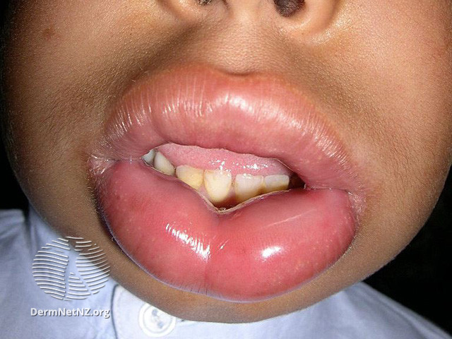File:Image provided by Dr Shahbaz A Janjua (DermNet NZ reactions-angioedema1).jpg