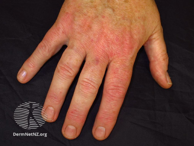 File:Irritant contact dermatitis (DermNet NZ atopic-dermatitis-hand).jpg