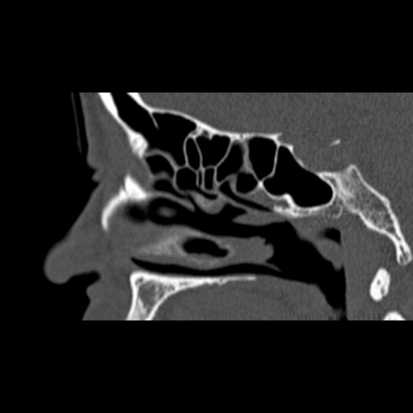 Nasal septal perforation (Radiopaedia 25030-25289 Sagittal bone window 41).jpg