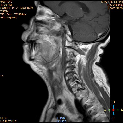 File:Nasopharyngeal carcinoma (Radiopaedia 22375-22403 Sagittal T1 C+ 10).jpg