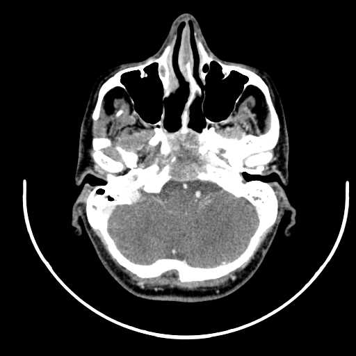 File:Nasopharyngeal carcinoma - infiltrating the clivus (Radiopaedia 62583-70875 Axial Post contrast 12).jpg