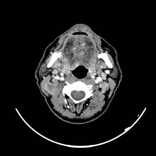 Nasopharyngeal carcinoma - infiltrating the clivus (Radiopaedia 62583-70875 Axial Post contrast 33).jpg