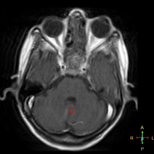 File:Nasopharyngeal carcinoma infiltrating the clivus (Radiopaedia 25229-25481 Axial T1 C+ 9).jpg